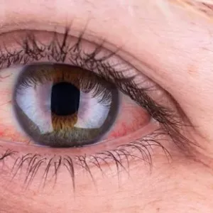 Причината за зачервяване на очите при възрастни и методи за лечение. Очни травми и заболявания
