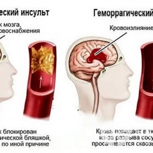 Колко време се престоява в болница при инсулт?? Лечение и характеристики на периода на възстановяване